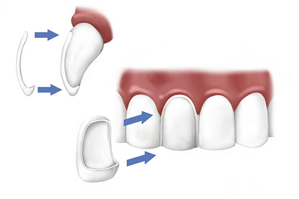 Carillas dentales - Clínica Dental - Equipo de la Torre - Dentistas en  Madrid