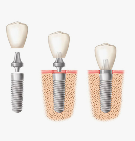 Implantes dentales de confianza