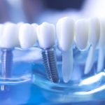 Implantes dentales de carga inmediata