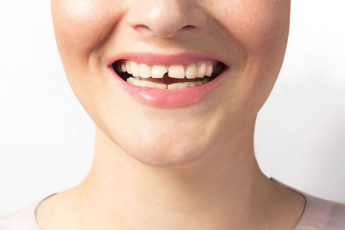 Traumatismos dentales