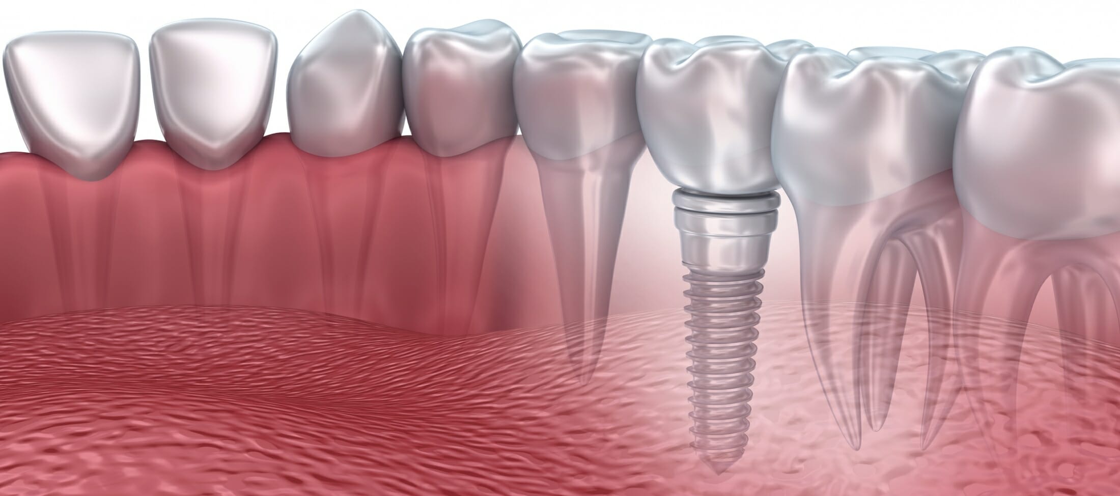 el-auge-de-la-implantolog-a-oral-es-realmente-un-tratamiento-adecuado